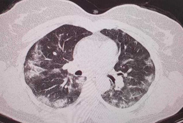 radiografie cu plamani infectati cu COVID-19