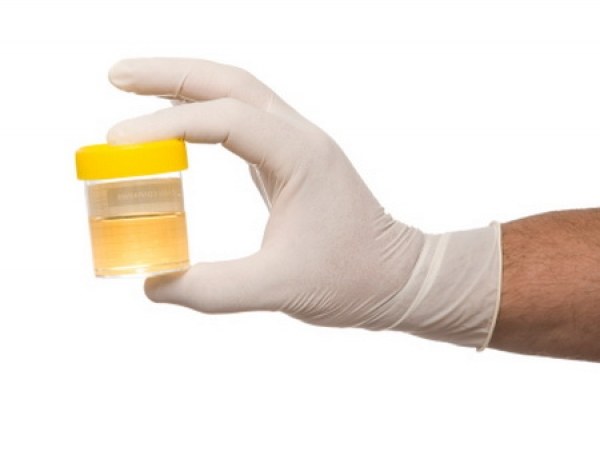 analiză urină