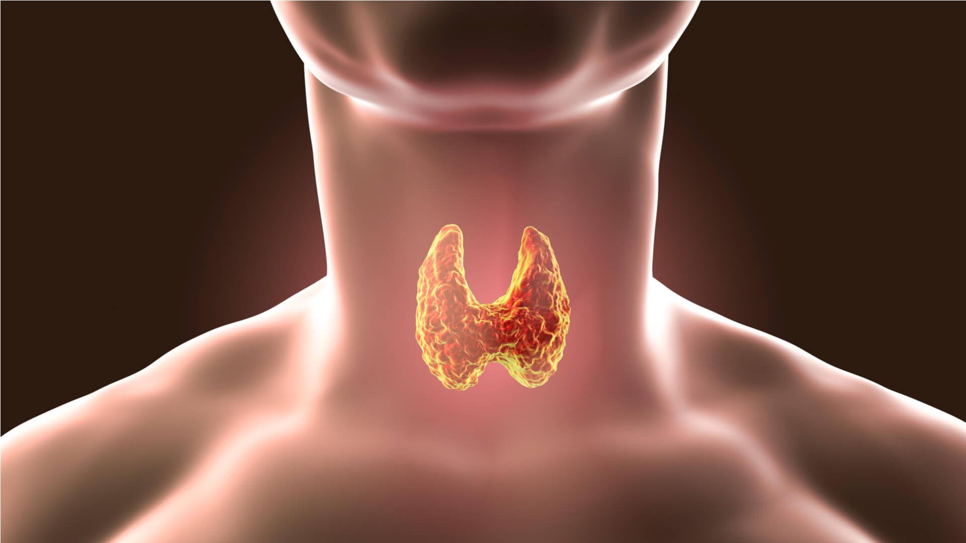 grafică persoană care suferă de o afecțiune a glandei tiroide