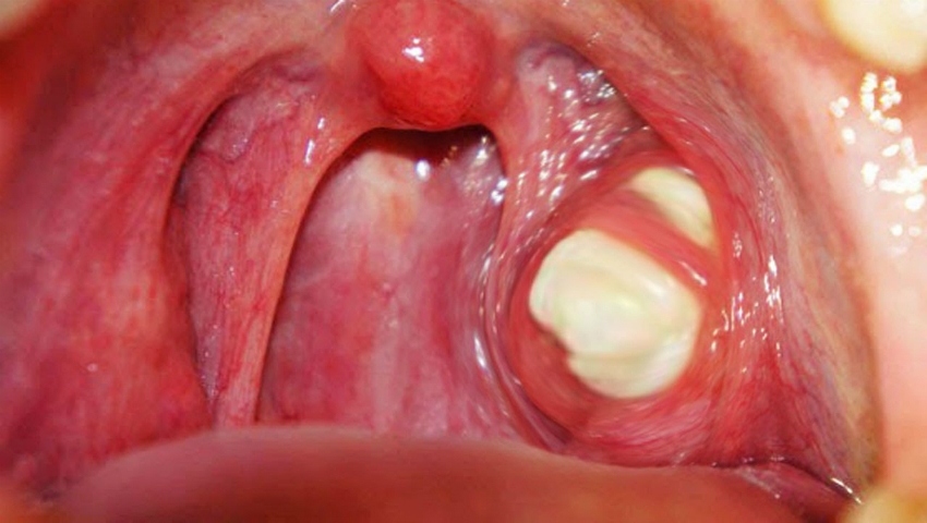 gură persoană care suferă de amigdalita pultacee