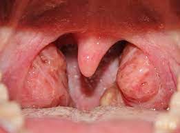 gură persoană care suferă de amigdalita pultacee
