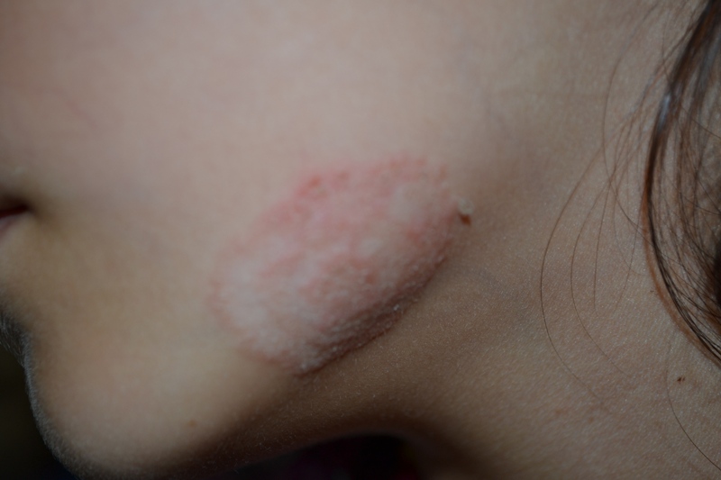 persoană care suferă de herpes circinat