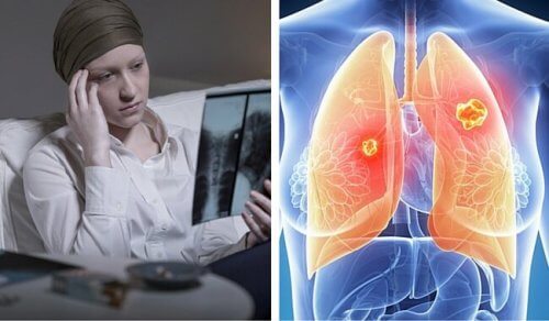 colaj o femeie bolnava de cancer ce priveste spre o radiografie pulomnara și grafica cu plamani afectati de cancer