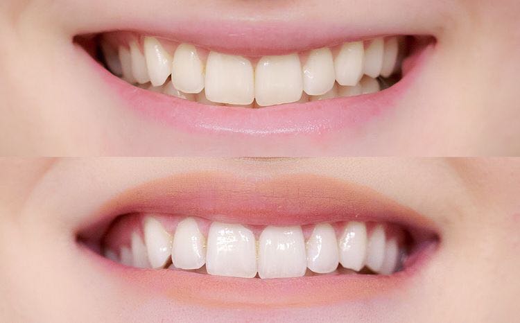 grafica gura unei persoane cu dintii albi si cu dintii ingabeniti