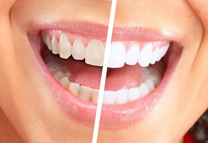 grafica gura unei persoane cu dintii albi si cu dintii ingabeniti
