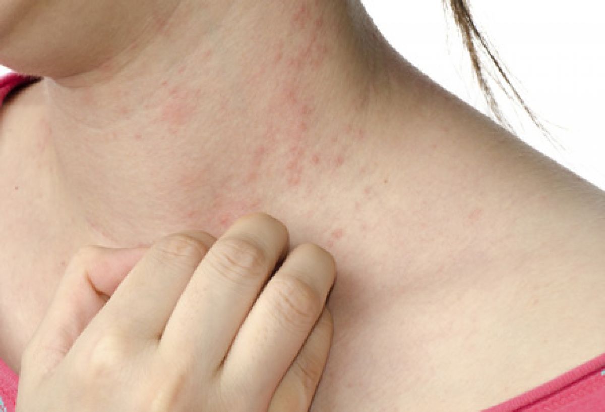 persoana care sufera de o reactie alergica la nivelul pielii