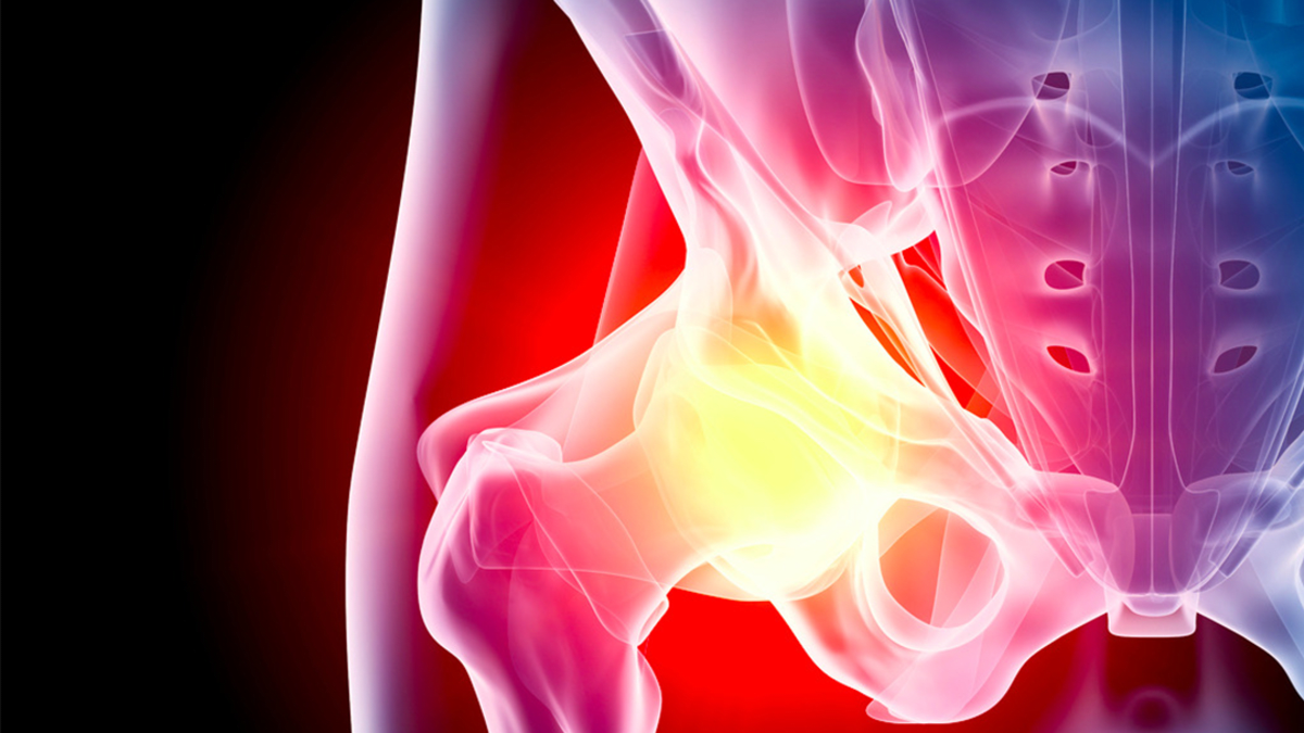 osteoporoza prezintă simptome la nivelul articulatiei soldului
