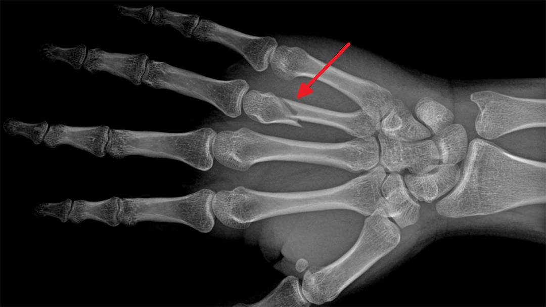 grafica unde se observa o fractura la un deget