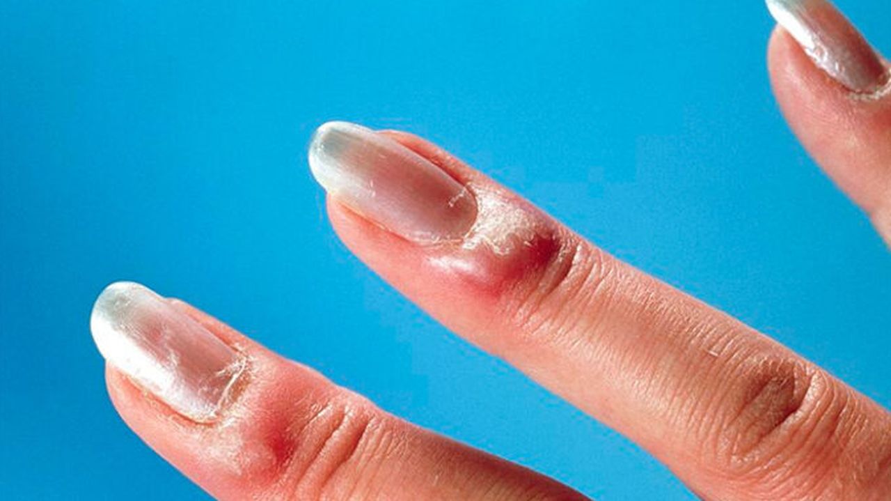 femeie care are degetele umflate
