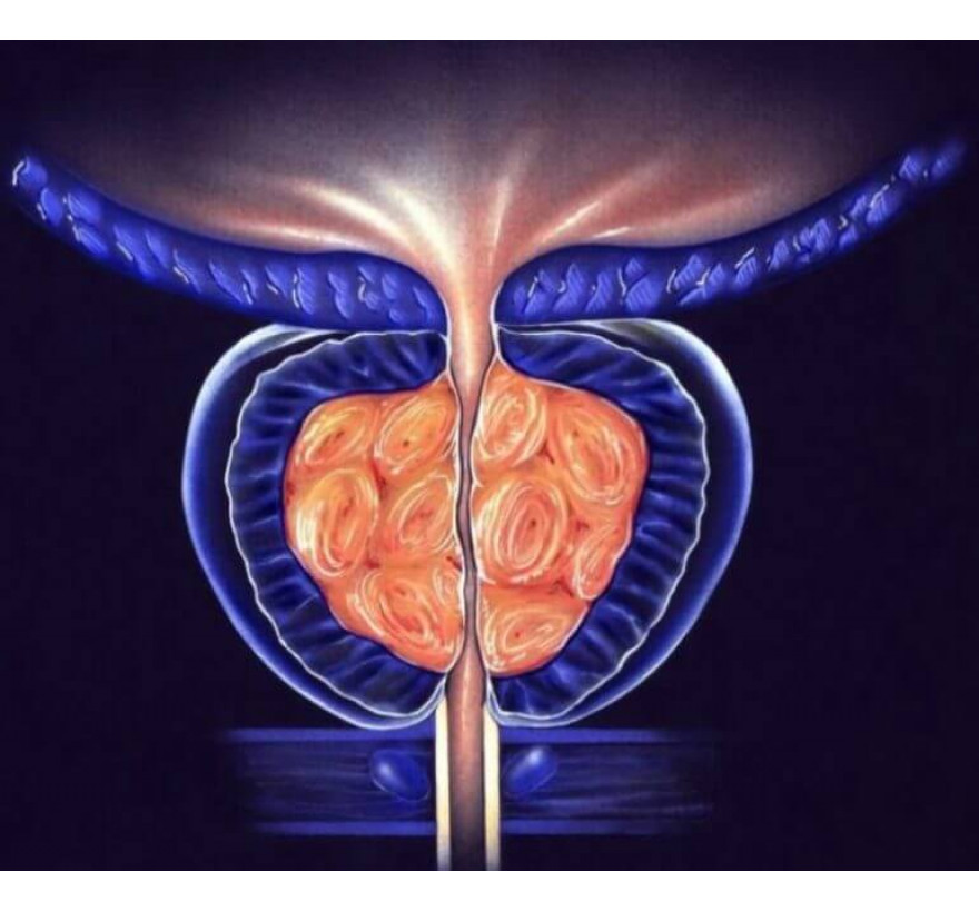 adenomul de prostata si berea merg bine