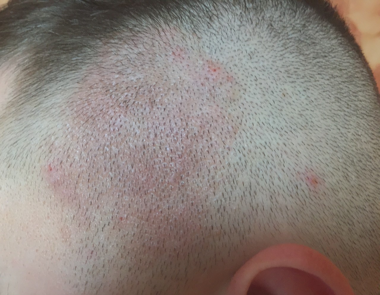 persoana care sufera de pete rosii pe scalp