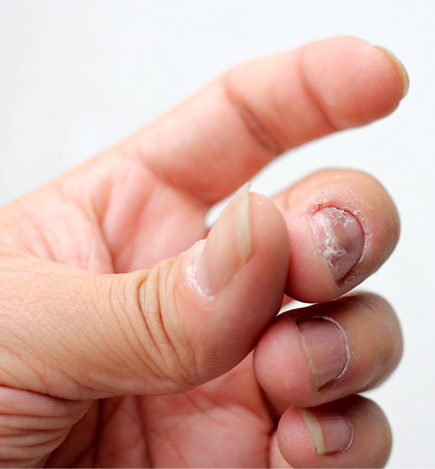 persoana care sufera de ciuperca la unghii