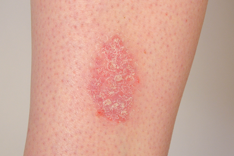 persoana care sufera de ciuperca pielii