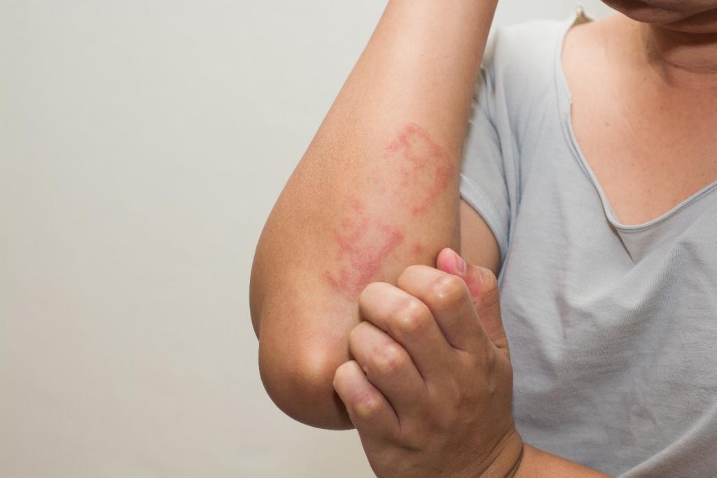 femeie care sufera de mancarimi ale bratului din cauza alergiei la caldura