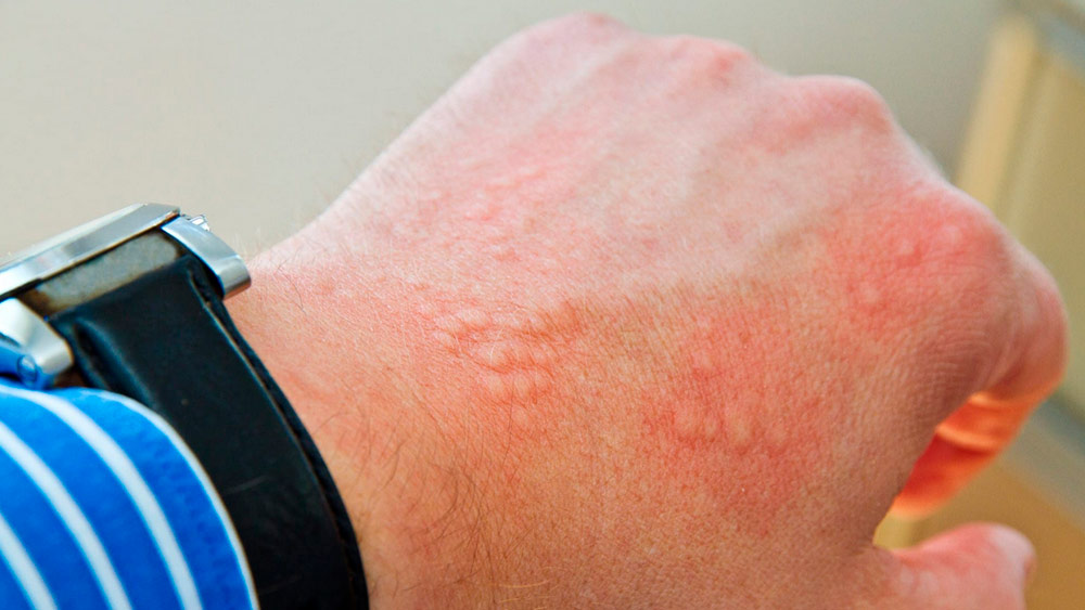 mana unei persoane care este acoperita de vezicule provocate de alergia la caldura