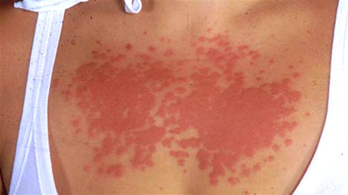 pieptul unei femei cu alergie la soare