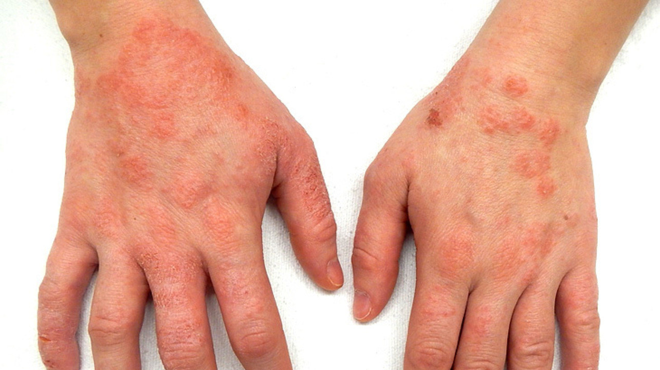 mainele unei persoane care sufera de eczema