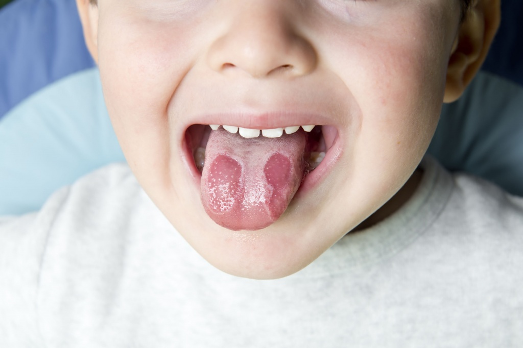 un copil care sta cu limba afara si sufera de stomatita
