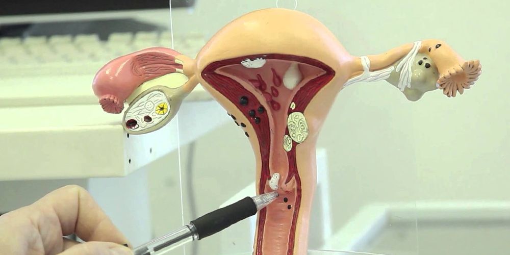 medic care arata cu pixul spre un chist situat pe un mulaj al colului uterin