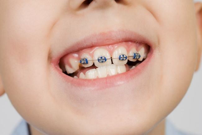 un copil care poarta aparat dentar