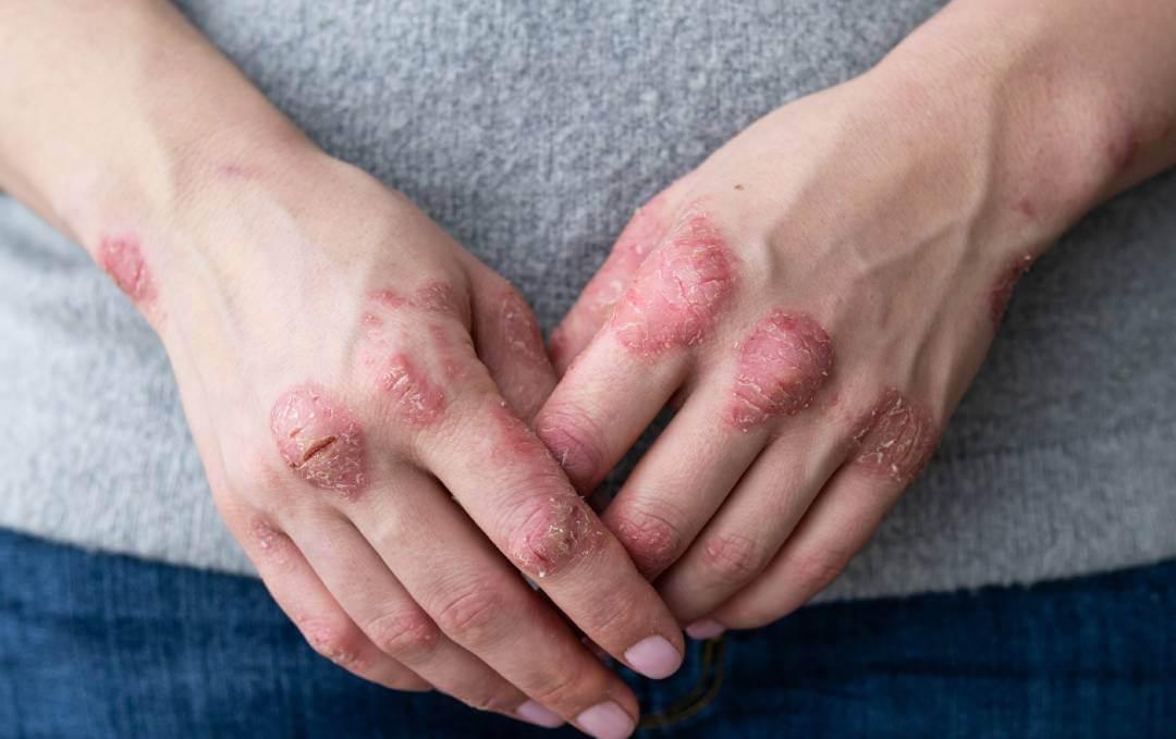 mainele unei persoane care sufera de dermatita atopica
