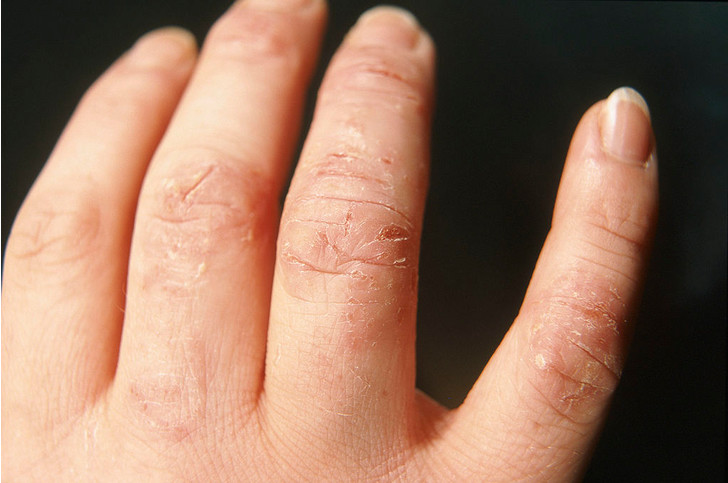 persoana care sufera de eczeme pe maini