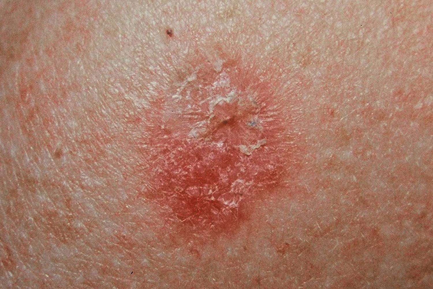 eruptie cutanata care semnalizeaza cancerul de piele