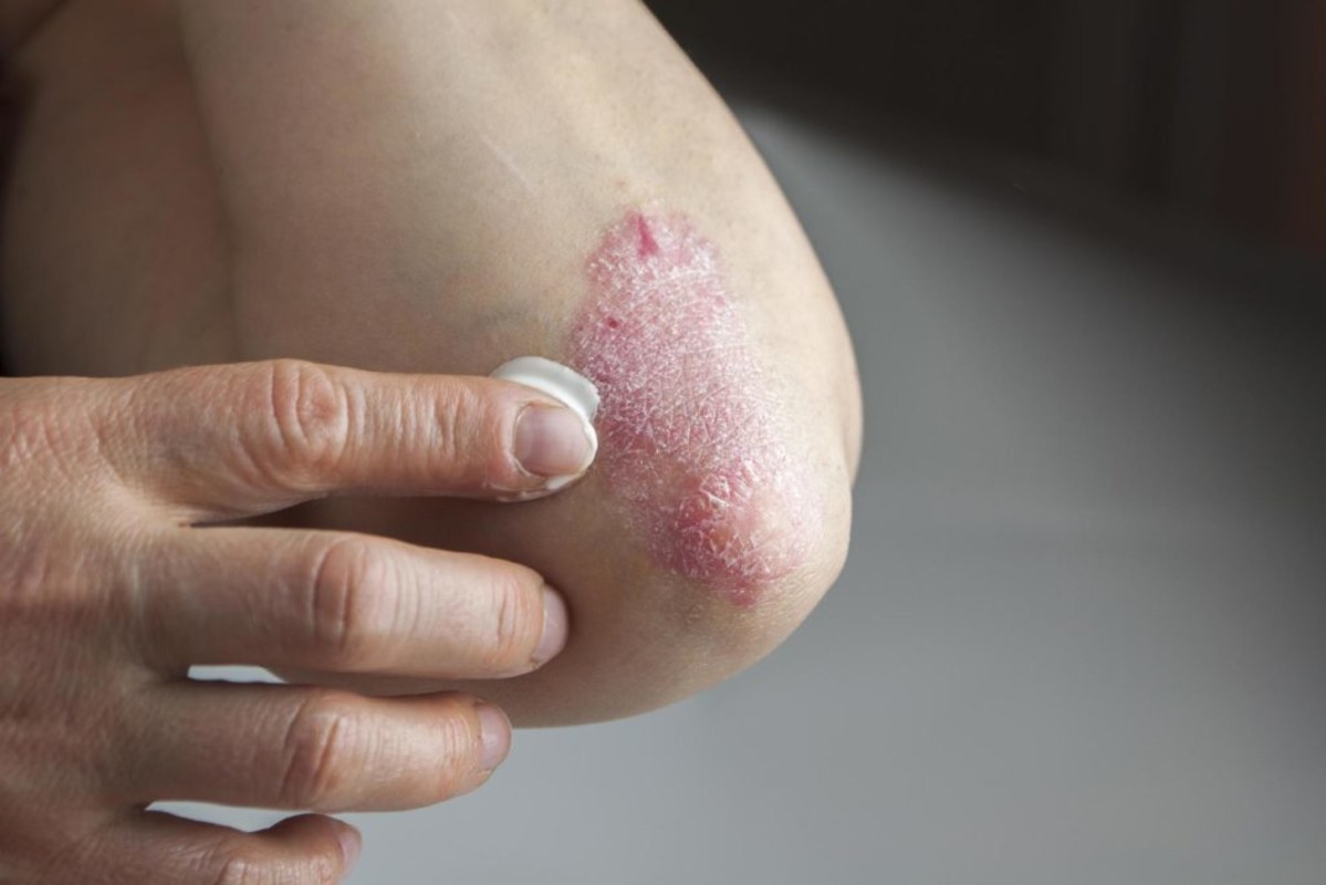 persoana care sufera de psoriazis vulgar si aplica pe cot o crema