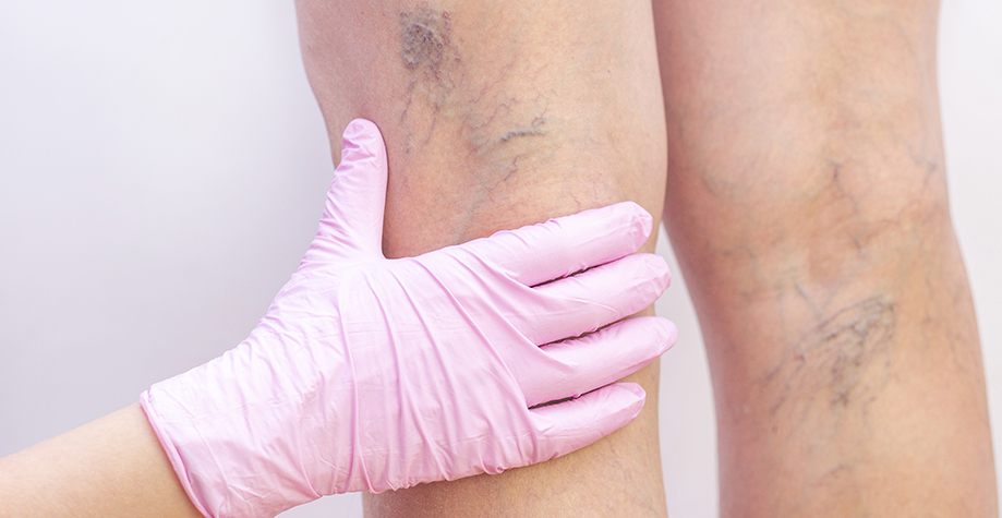 medic care examineaza varicele de pe picioarele unei persoane