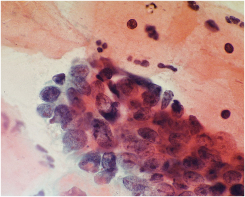 celule endocervicale prezente in analiza la nivelul microscopului