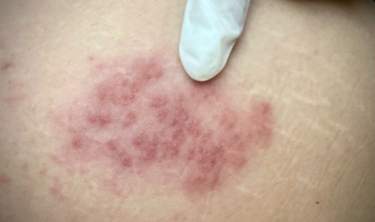 piele afectata de noul virus al gripei tomatelor