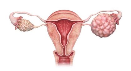 reprezentare a unei tumori ovariene