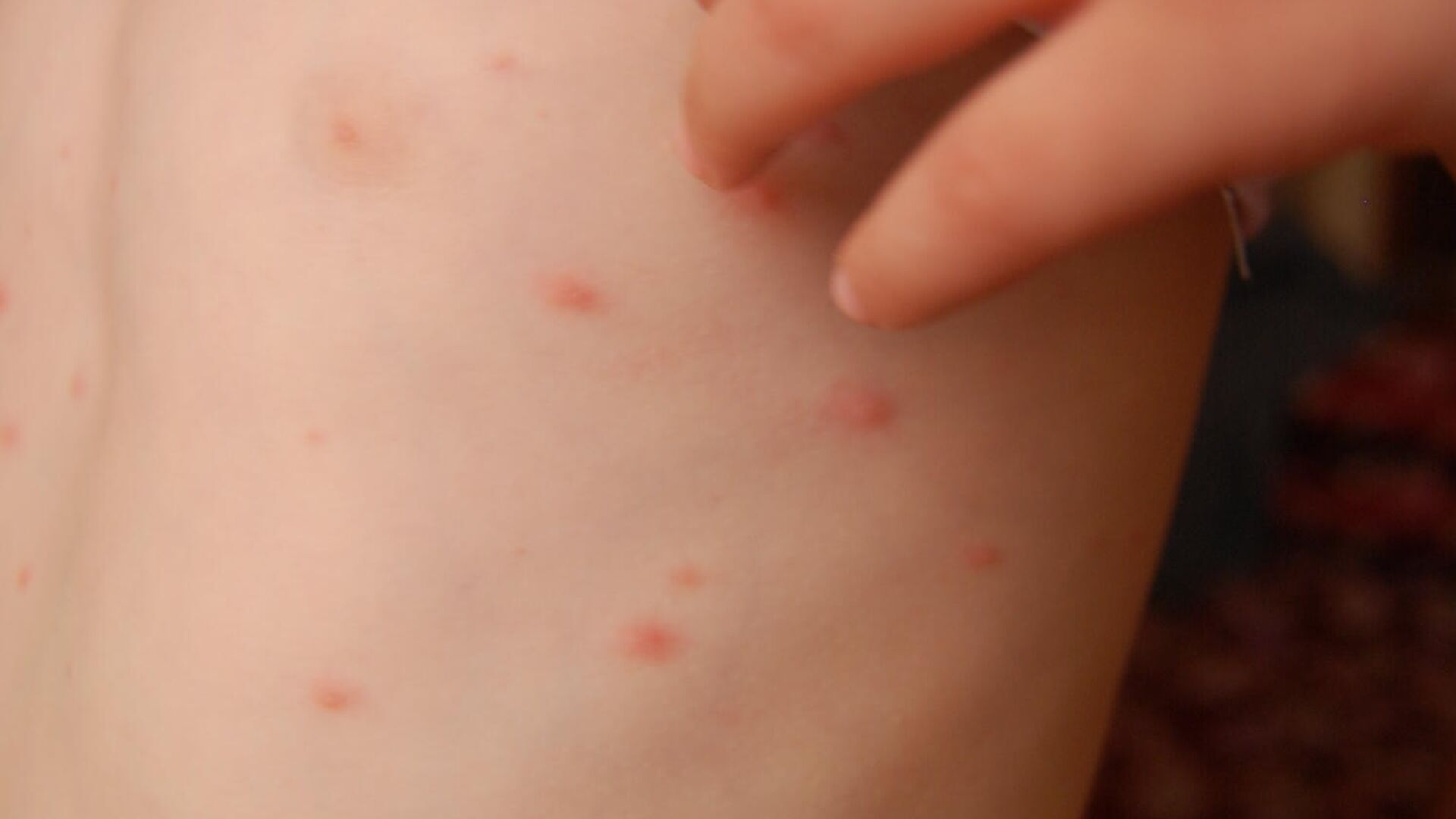 copil care sufera de varicela