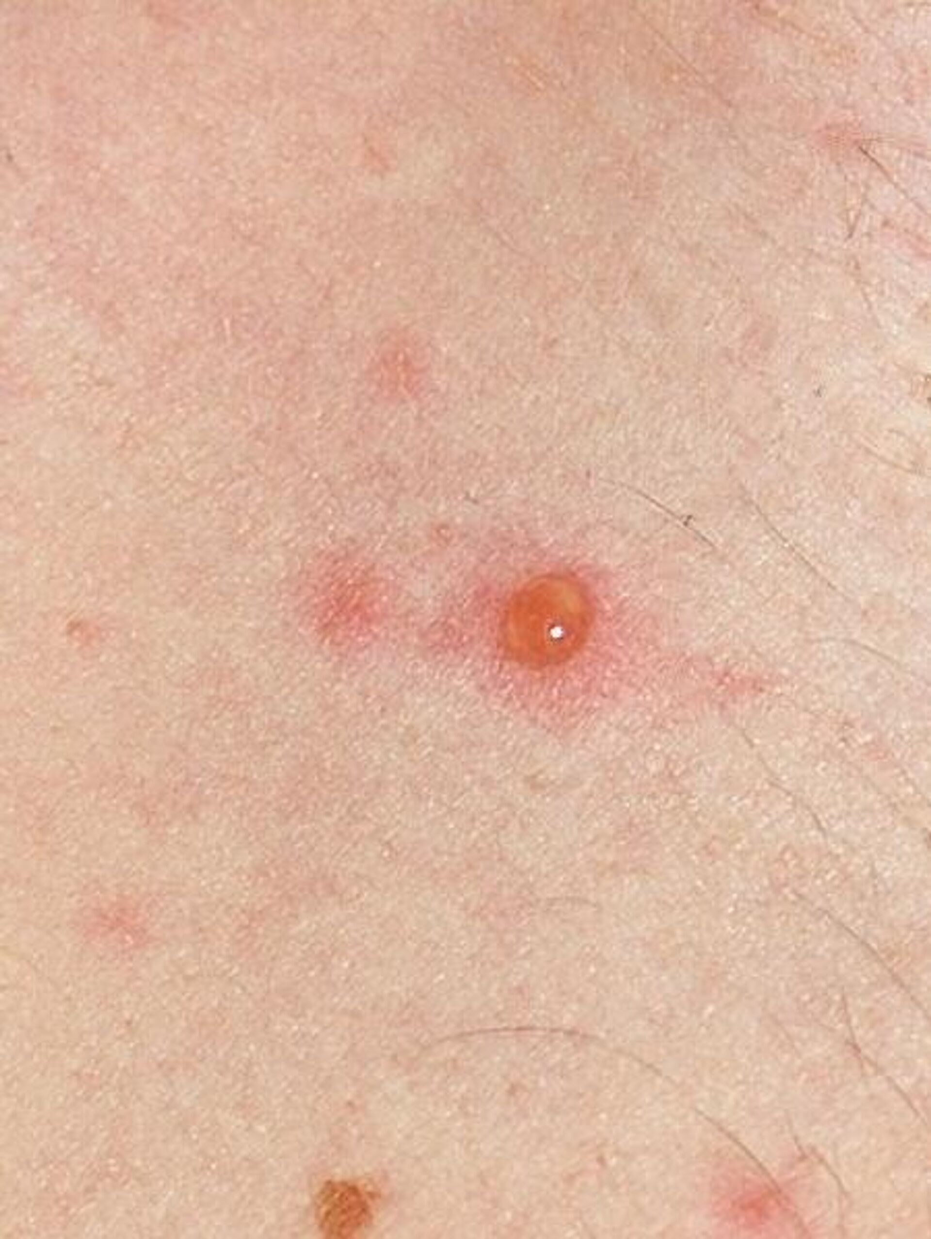 bubite pe corpul unei persoane cauzate de varicela