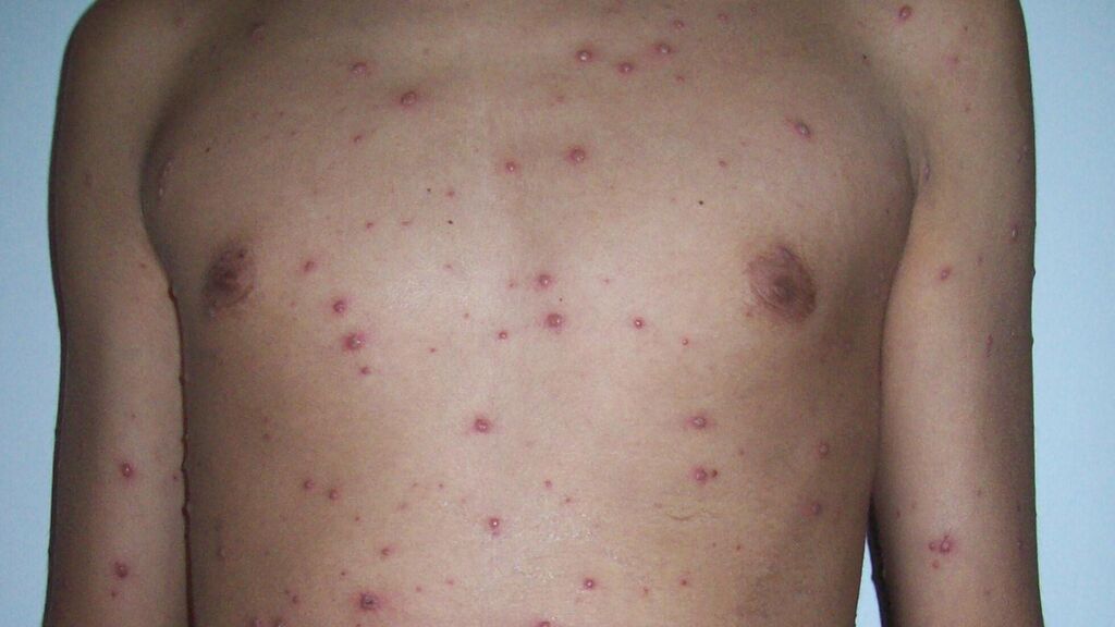 corpul unui copil acoperit de bube provocate de varicela
