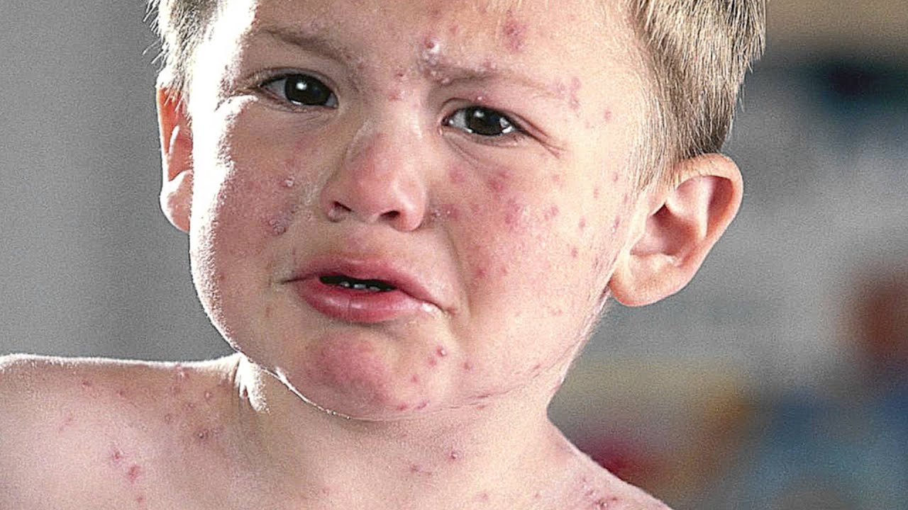 copil care plange si are pe fata bube provocate de varicela
