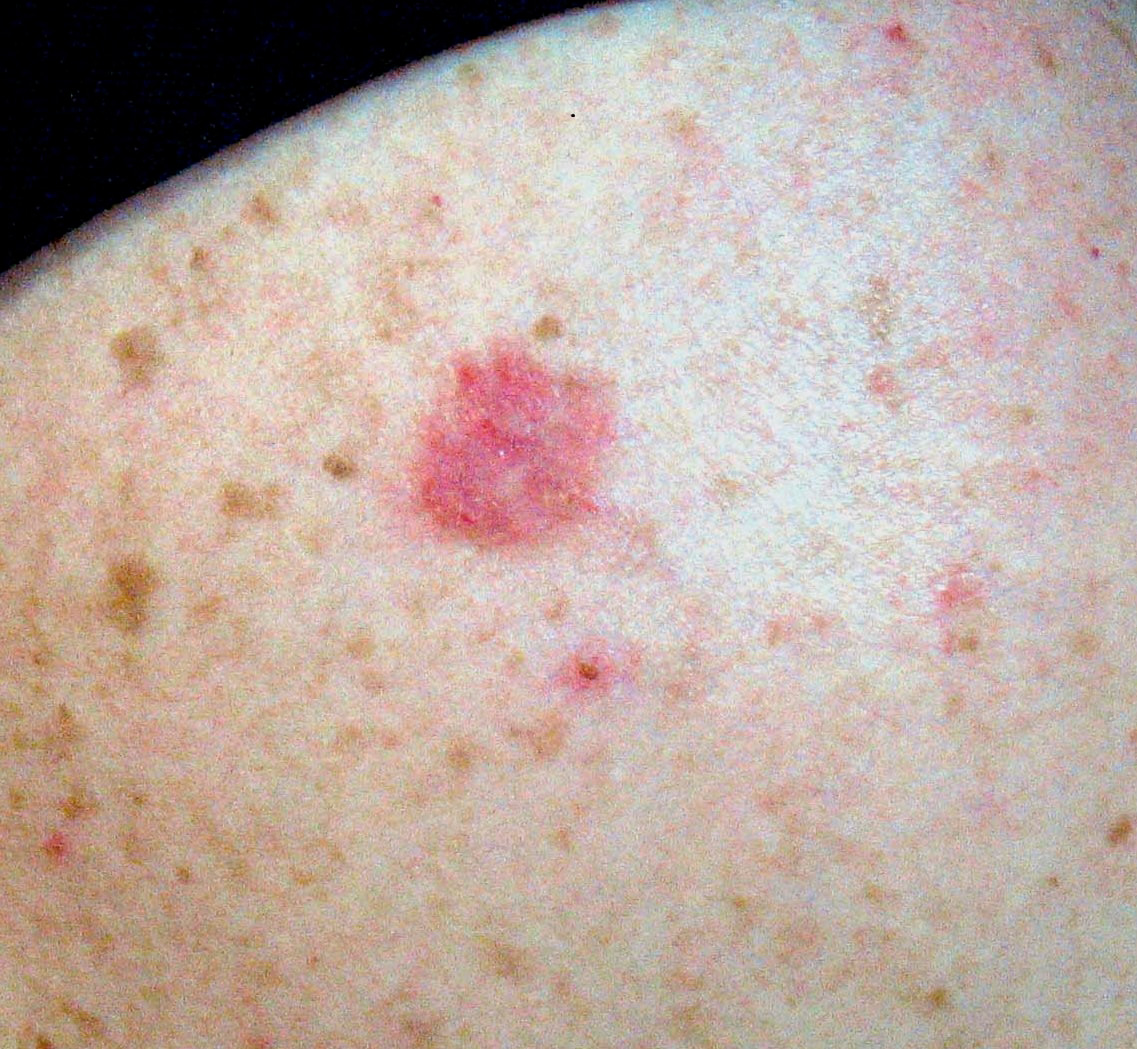 eruptie cutanata pe pielea unei persoane