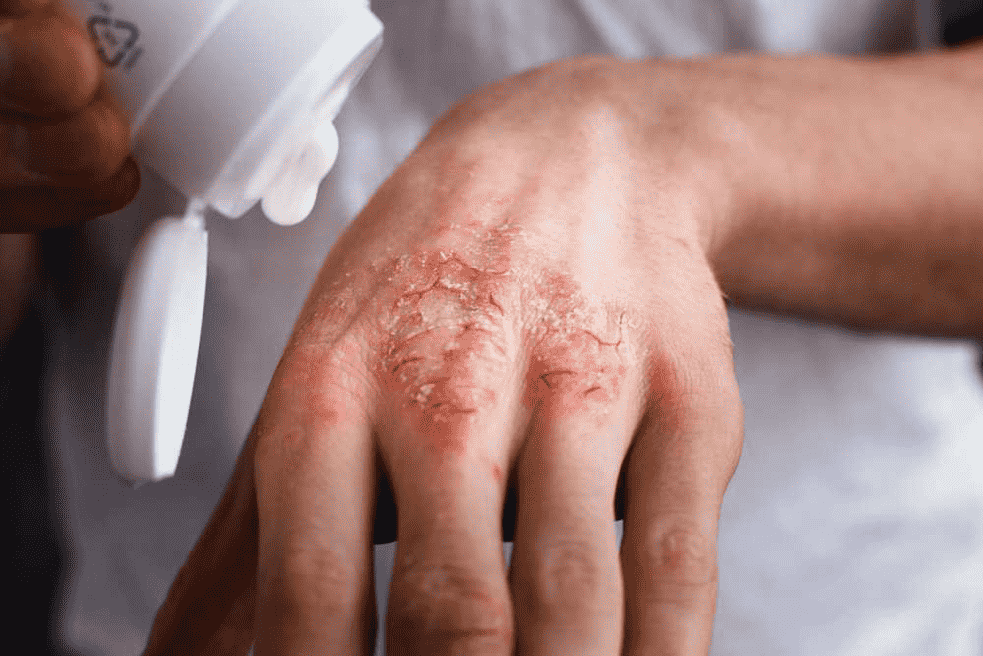 persoana care aplica o crema pe o eruptie cutanata provocata de eczema