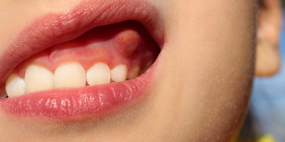 femeie care sufera de abces dentar