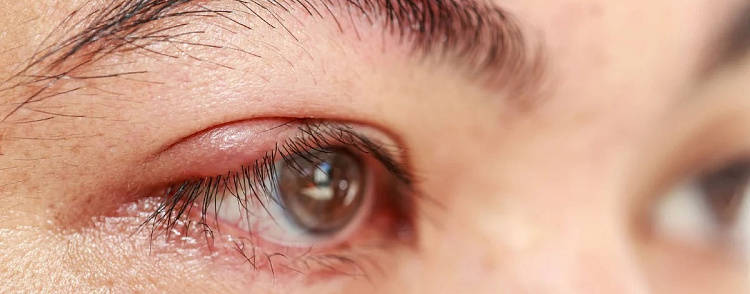 ochiul afectat de o boala a unei persoane