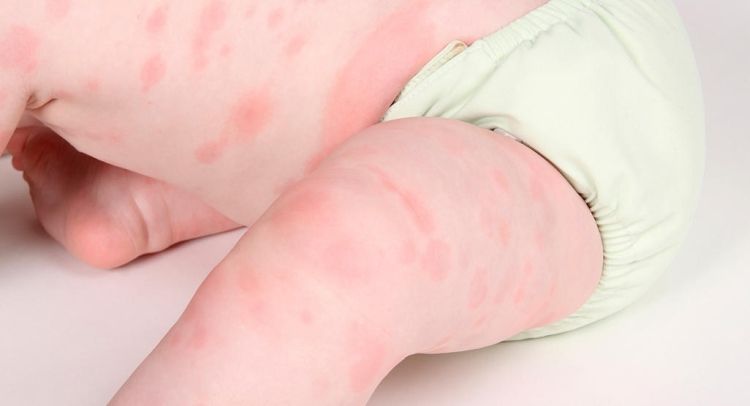 eruptii cutanate pe corpul unui copil provocate de o alergie