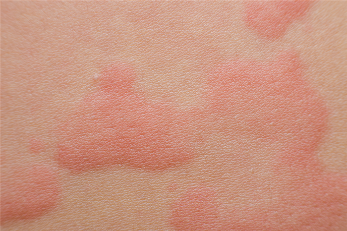 eruptii cutanate pe corpul unui copil provocate de o alergie