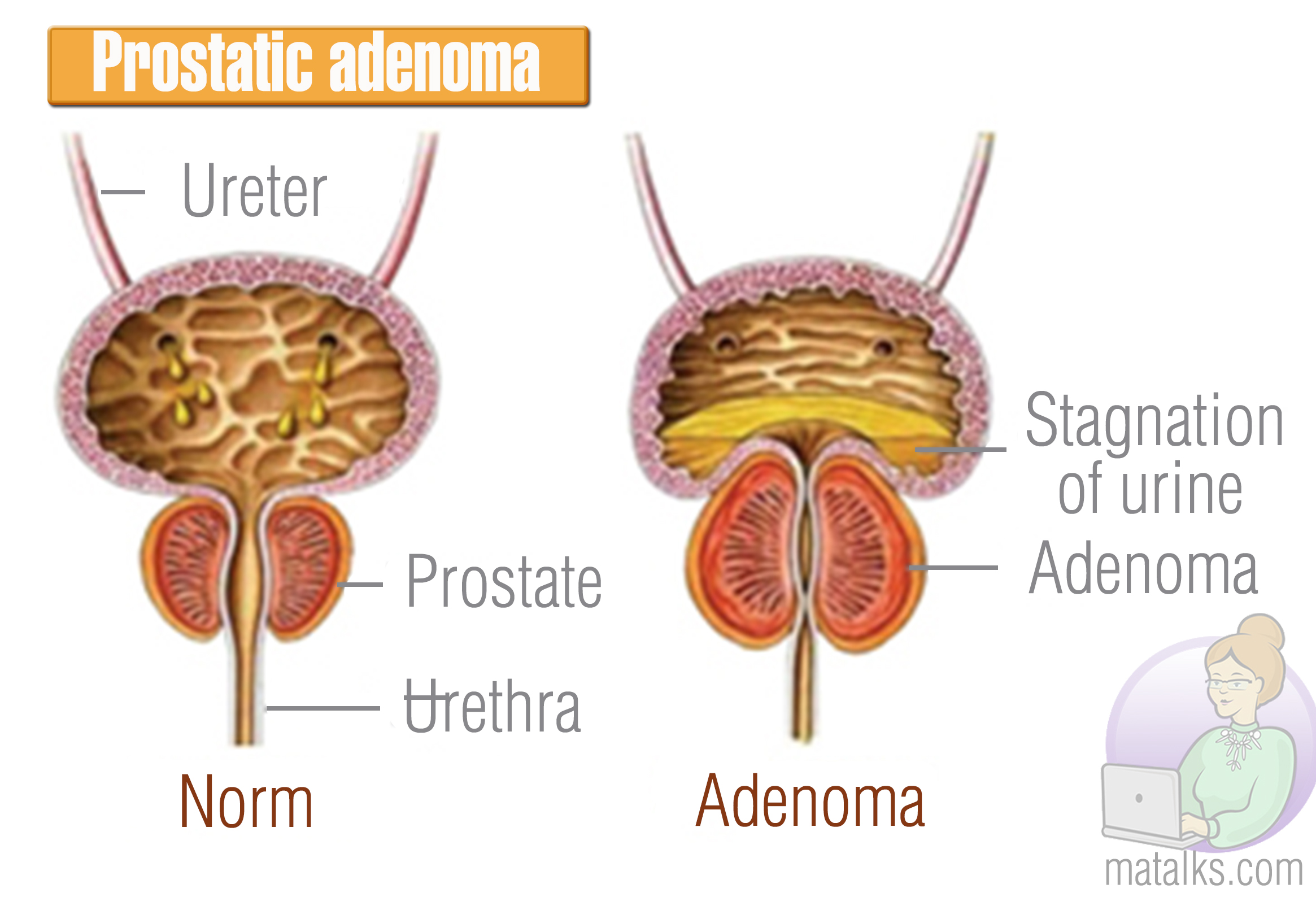 Как лечить гиперплазию предстательной железы у мужчин. Аденома предстательной железы схема. Доброкачественная гиперплазия (аденома) предстательной железы. Строение аденомы простаты. Схема лечения аденомы предстательной железы у мужчин.